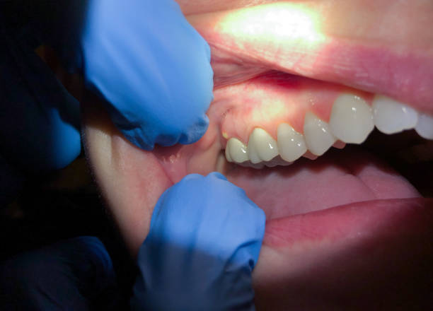 Best Emergency Gum Treatment in Elgin, MN